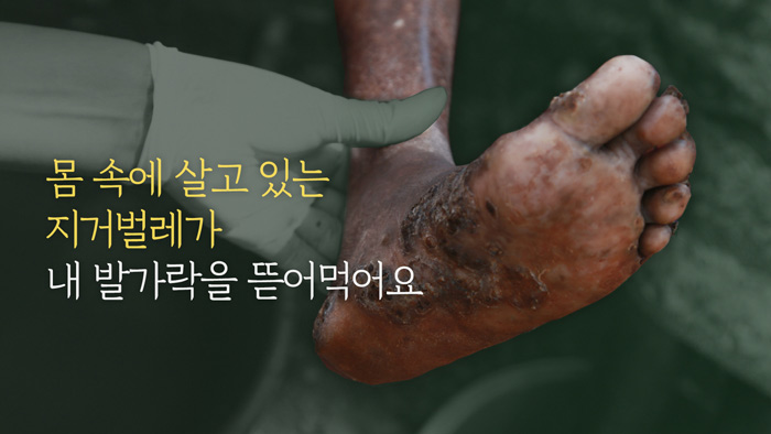 몸 속에 살고 있는 지거벌레가 내 발가락을 뜯어 먹어요